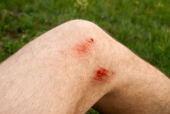 A grazed knee broken skin